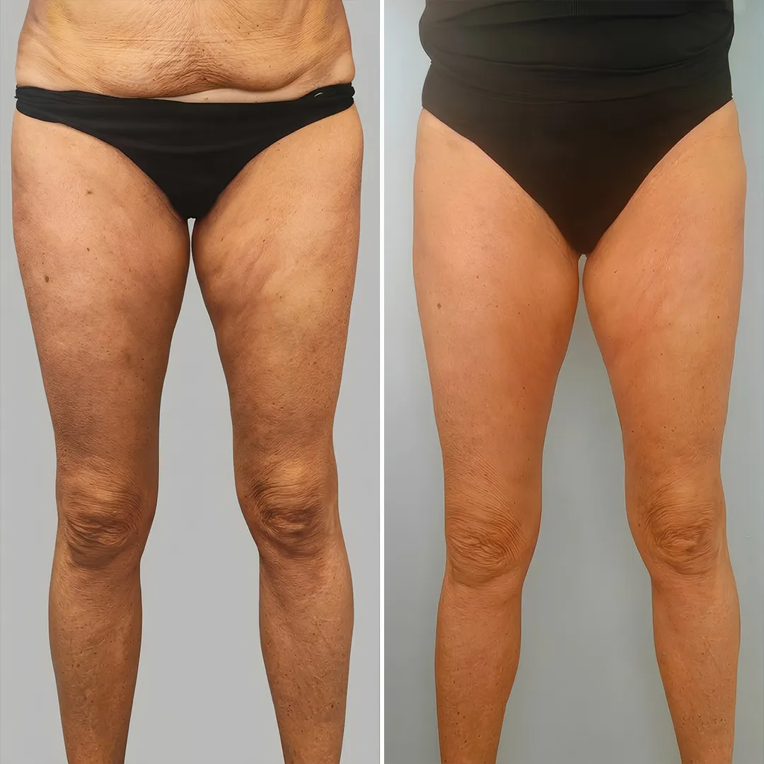 Risultati prima e dopo il trattamento corpo